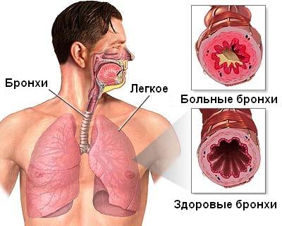 фото - бронхиальная астма